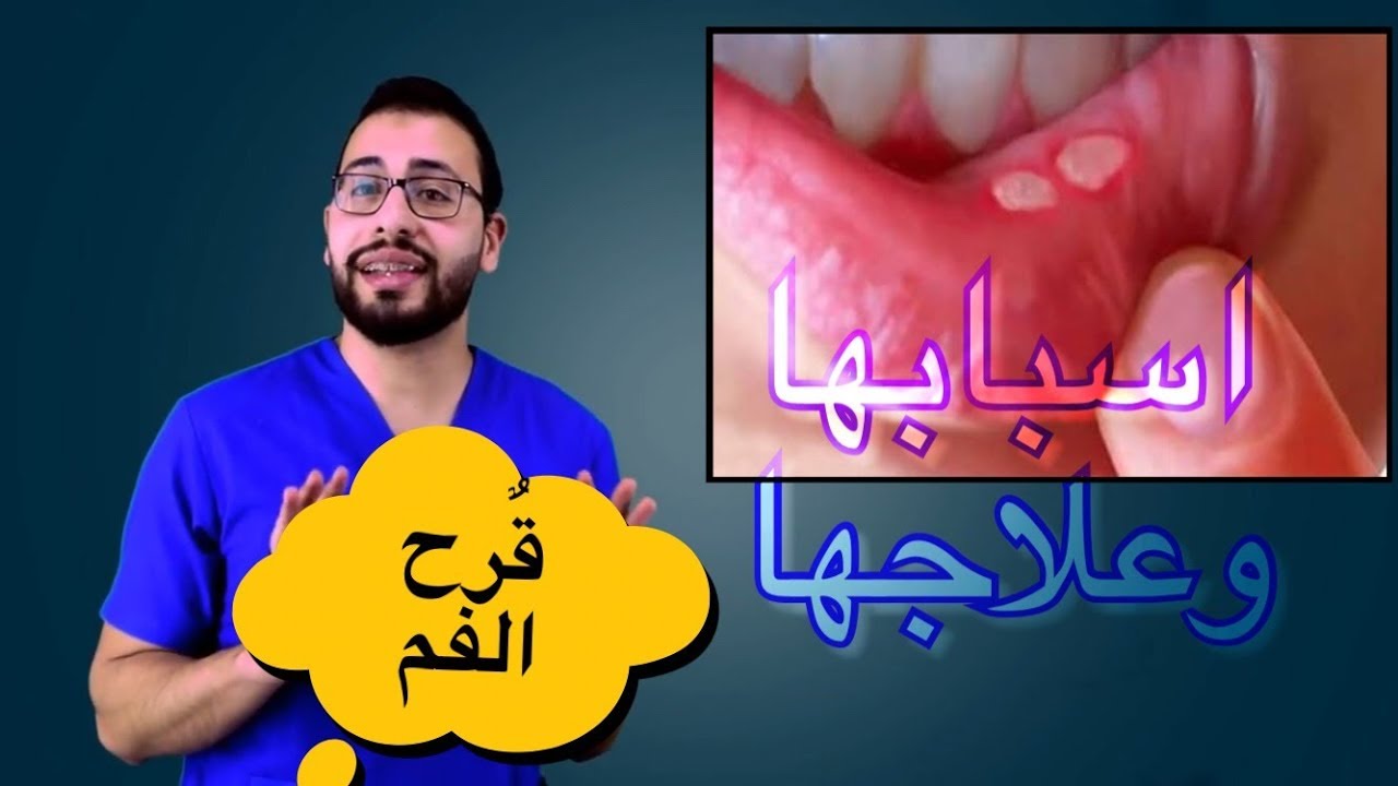 معقول تكون دى المنتجات دى هى علاج قرح الفم , علاج تقرحات الفم