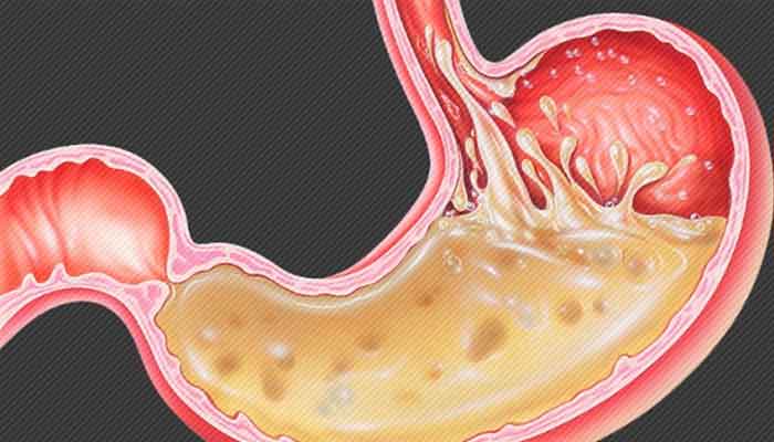 حرقان فم المعدة , اسباب و علاج حرقان فم المعدة