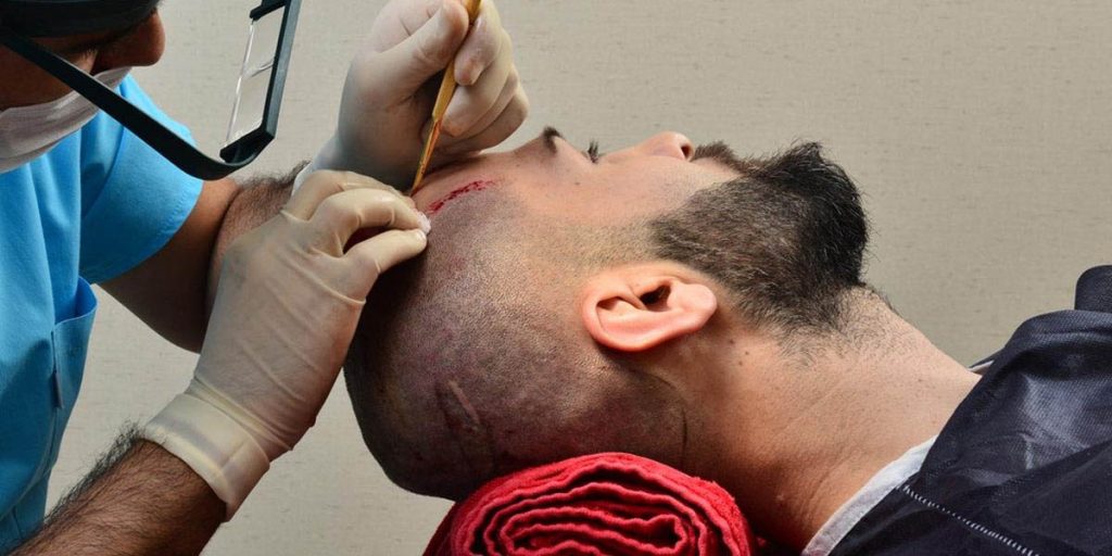 احدث طرق زراعة الشعر 2019 - تقنيات زراعة الشعر الحديثة 1345 2