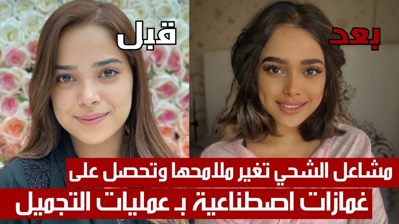 مش ممكن صور لعمل الغمازات اخيرا-عملية تجميل غمازات 542