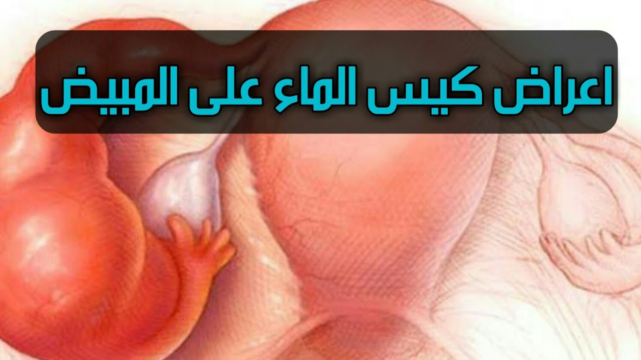 اعراض وجود اكياس على المبيض 1104 1