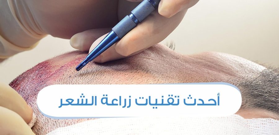 احدث طرق زراعة الشعر 2019 - تقنيات زراعة الشعر الحديثة 1345