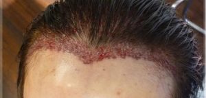 اضرار زراعة الشعر , عيوب زراعه الشعر