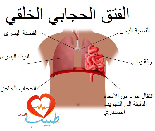 علاج فتق الحجاب الحاجز بالاعشاب , علاجات للجسم بالاعشاب