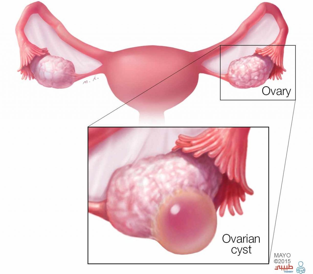 اعراض وجود اكياس على المبيض 1104