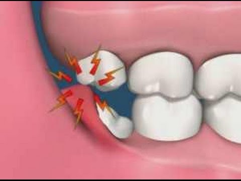 الام ضرس العقل - وجع ضرس العقل واعراضه 3142 2