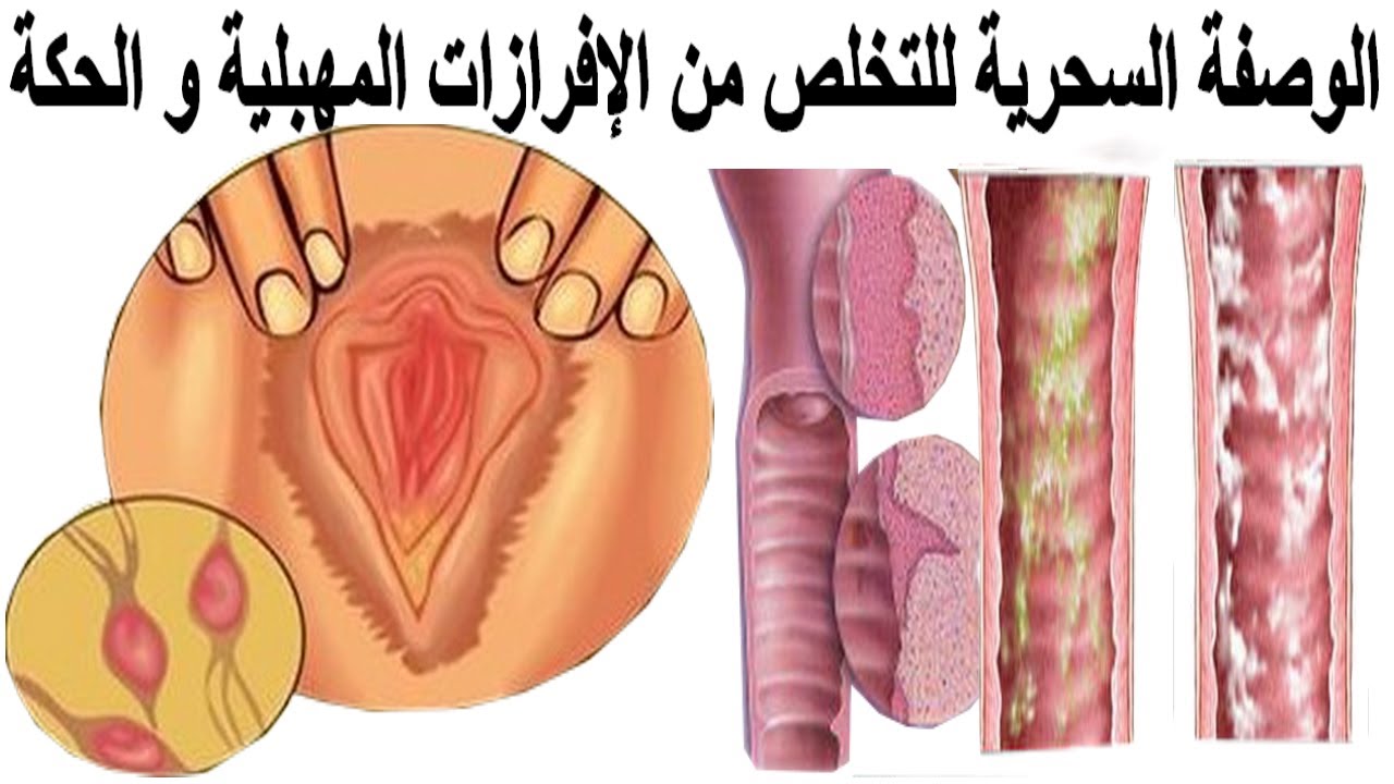 علاج افرازات المهبل البيضاء - مشكلة افرازات المهبل و حلها 2493 3