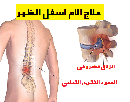 كيف تعرف سبب وجع ظهرك - سبب الم اسفل الظهر 1718 1