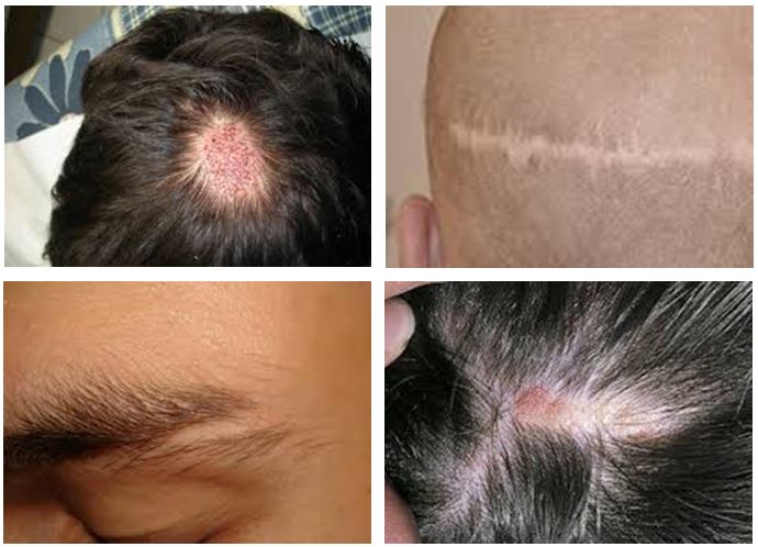 زراعة الشعر بدون حلاقة , هل عملية زرع الشعر مفيده