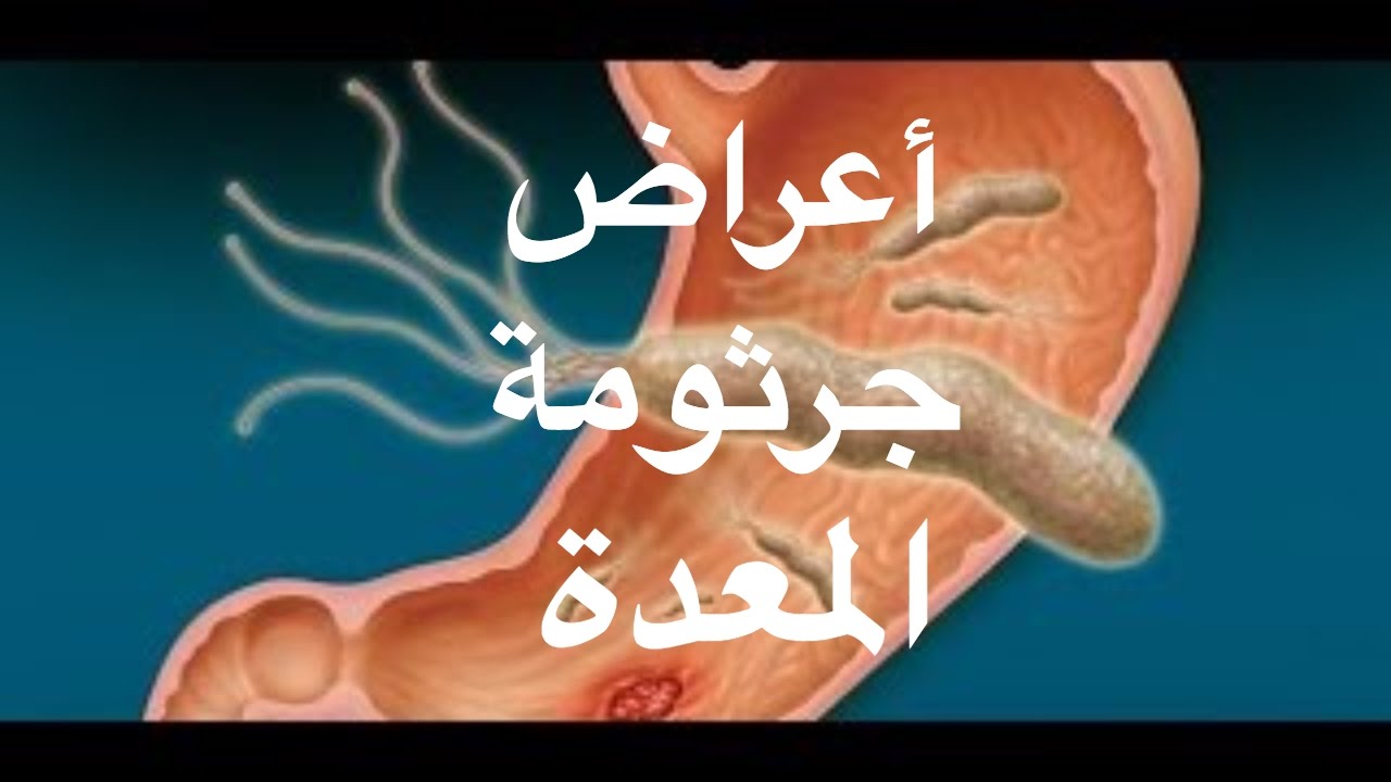 اعراض علاج جرثومة المعدة - مرض الجرثومة الملوية البوابيه 1655 3