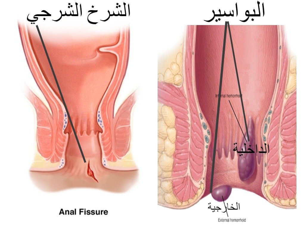 احسن علاج للبواسير - نصائح فعاله للامراض المزعجه 1340 3