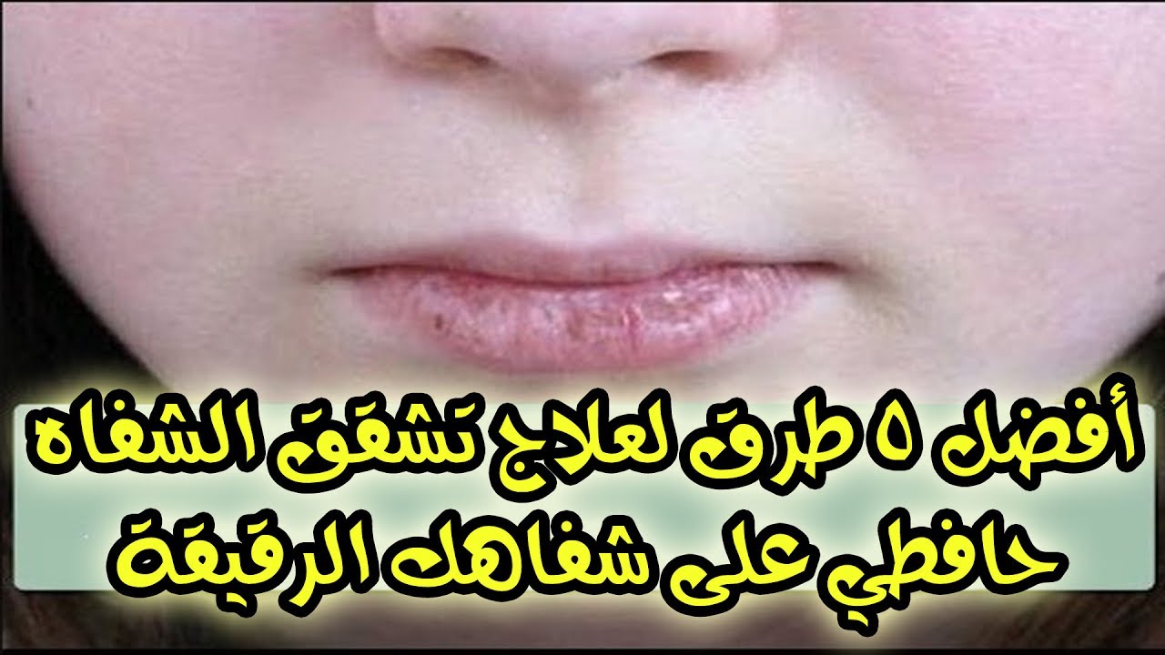 نصائح طبيعية لعلاج تشقق الشفاه-علاج تشقق الشفاه بسرعه 435 6