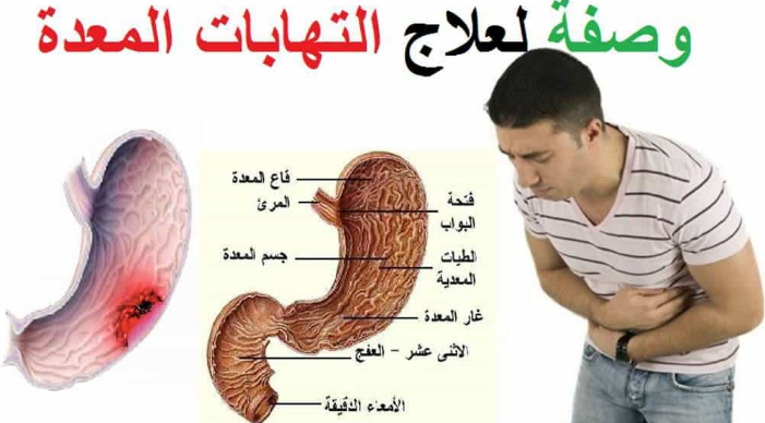 علاج التهاب المعدة بالاعشاب , وصفات تخلصك من التهاب المعده