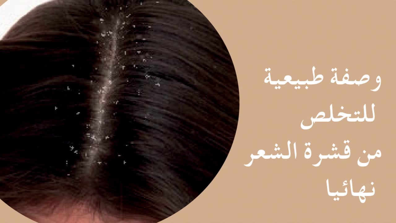 كيفية التخلص من قشرة الشعر والتخلص منها نهائيا الحزن والألم